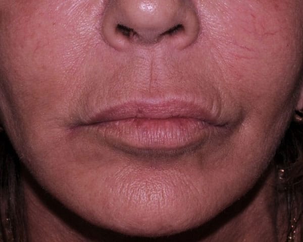 Lip Lift Before & After | Dr. Becker