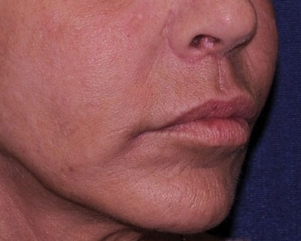 Lip Lift Before & After | Dr. Becker