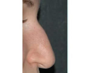 Rhinoplasty Before & After | Dr. Becker
