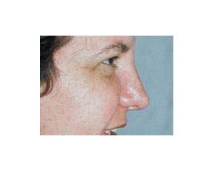 Rhinoplasty Before & After | Dr. Becker