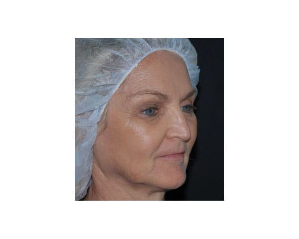 Non Surgical Facelift Before & After | Dr. Becker