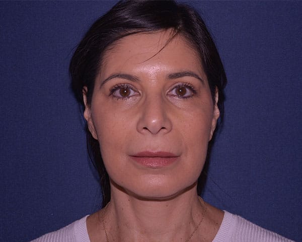 Non Surgical Facelift Before & After | Dr. Becker