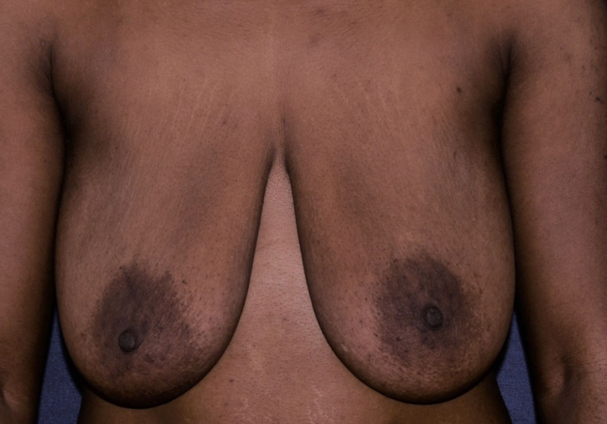 Virtually Scarless Breast Lift