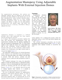 Augmentation Mastopexy Using Adjustable Implants With External Injection Domes