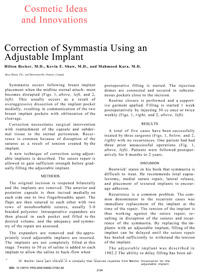 Correction of Symmastia Using an Adjustable Implant
